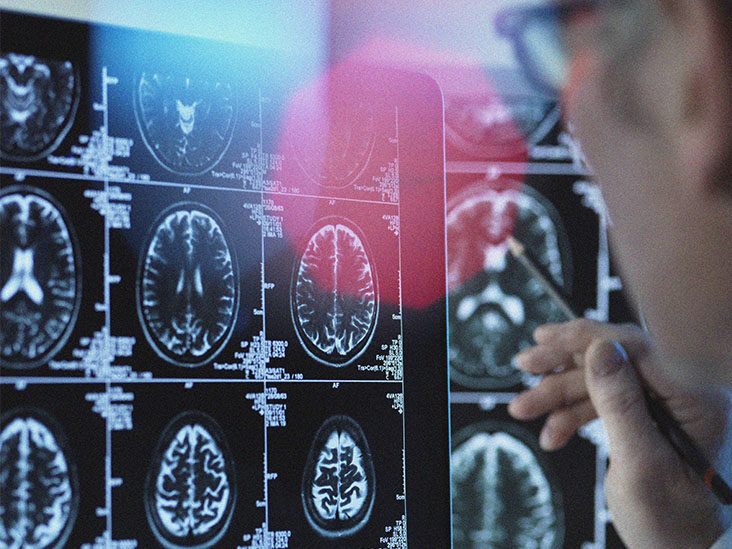 Thing you Need to Know About Medicare Coverage for Epilepsy
