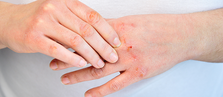 Shingles Complications in the Elderly And How Medicare Can Help